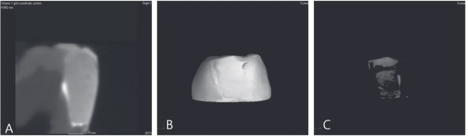 Fig. 1. Marginal leakage assessment (A) 2D image from a FB sample of the penetrant along the tooth - restoration interface