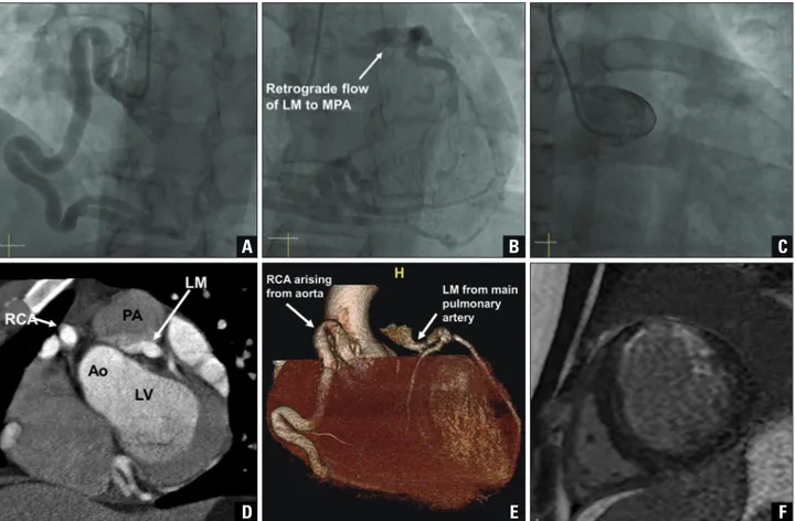 Fig. 2. Coronary angiography showing an enlarged and tortuous RCA from Ao (A). Retrograde filling of LCA through abundant collaterals from RCA  and abnormal shunt flow from left main stem to main PA (B)
