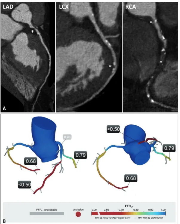 Fig. 1. A 62-year-old Caucasian man visited due to exertional chest pain. A: Multiplanar reformat of a CT angiogram demonstrated a severe stenosis  lesion in proximal LAD, a moderate to severe stenosis in middle LCX, severe stenosis in proximal RCA and sus