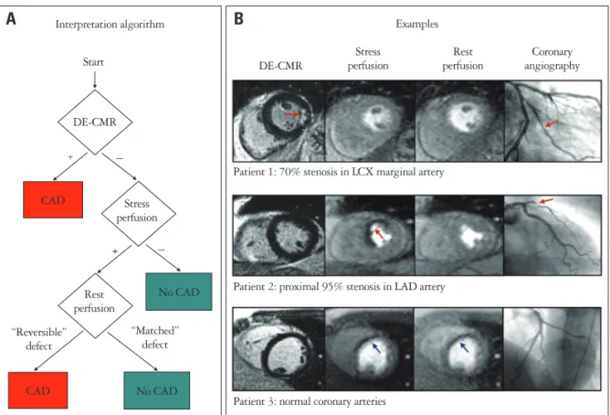 Fig. 3 demonstrates CMR images in a patient with palpita- palpita-tions who did not have any symptoms or signs of CAD