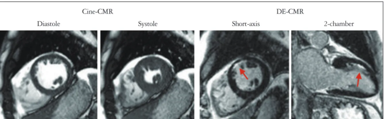 Fig. 3. Cine and delayed-enhancement images in a patient without signs or symptoms of coronary artery disease who was believed to have a  structurally normal heart