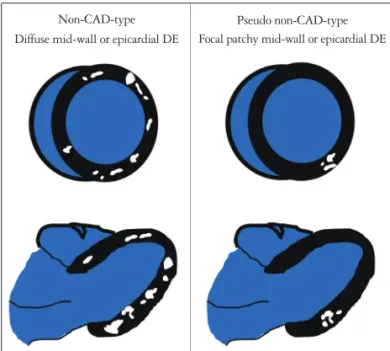 Fig. 4. The cartoon schematic on the left demonstrates multiple islands  of hyperenhancement in a diffuse, near global pattern, which is classic  for particular types of viral myocarditis