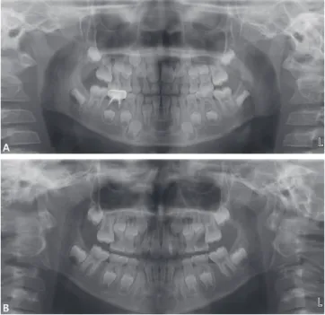 Fig. 1. Ectopic eruption of the maxillary first permanent  molar. (A) Unilateral, (B) Bilateral.
