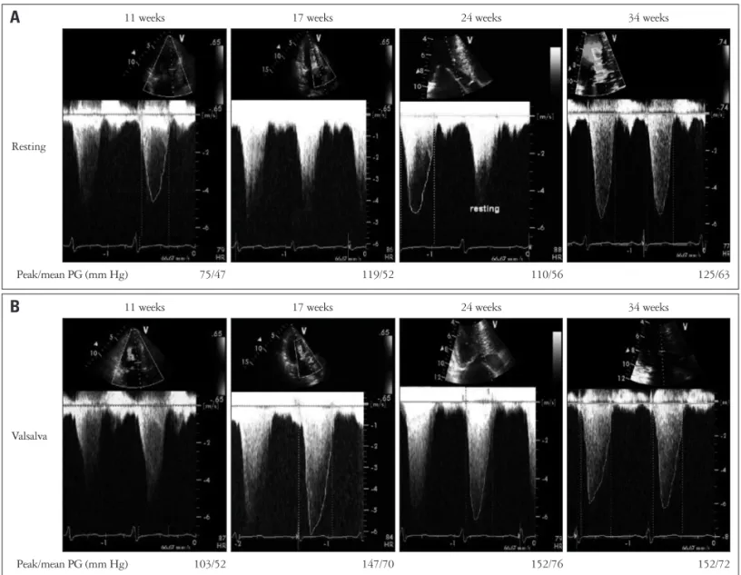 Fig. 2. Serial check up of left ventricular outflow tract (LVOT) pressure gradient (PG) presented by M-mode at resting (A) and during the Valsalva  maneuver (B)