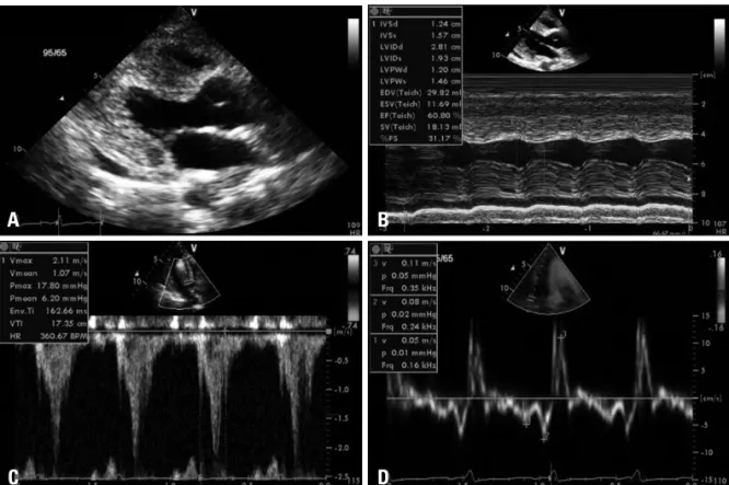 Fig. 5. The echocardiography after infusion of infliximab showed still increased left ventricular (LV) wall thickness but improved LV systolic function (A  and B) and velocity time integral from LV out flow track and myocardial tissue velocities (C and D).