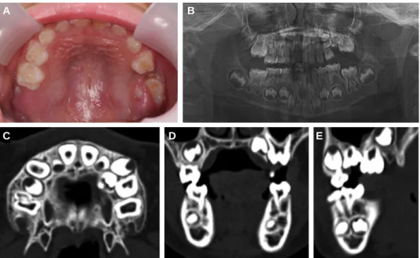 Fig. 1. At first examination. (A) intraoral photo. Infraocclusion of the maxillary left second primary molar being covered by the surrounding tissues