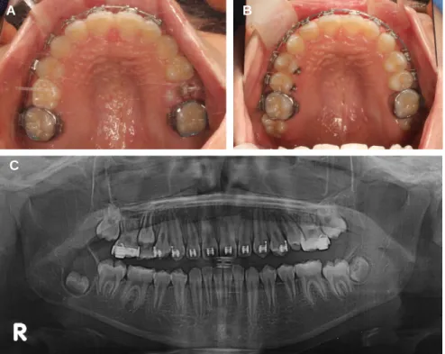 Fig. 5. Sign of spontaneously eruption (A) and complete eruption (B, C) of upper left second premolar.