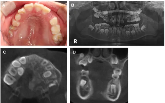 Fig. 8. After surgical removal of ankylosed second primary molar.