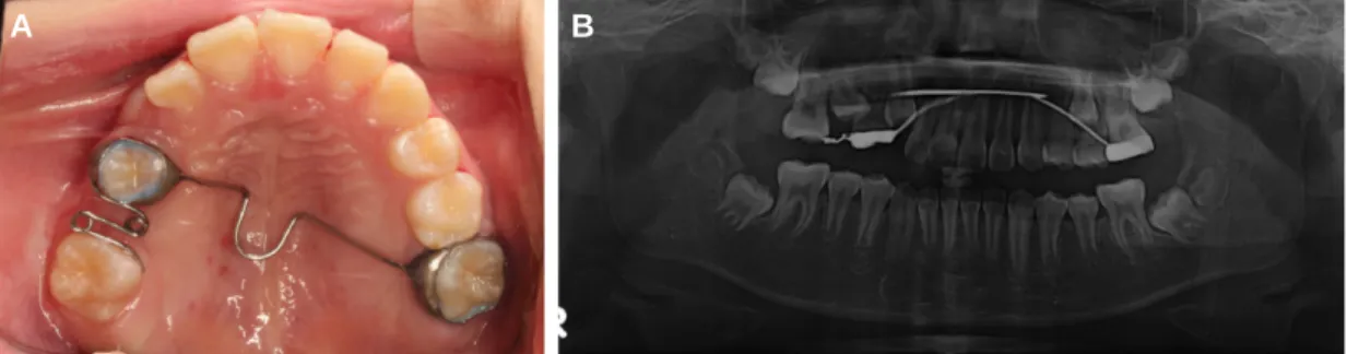 Fig. 11. follow-up examination of 2 years; Normal eruption of Upper right second premolar is observed.