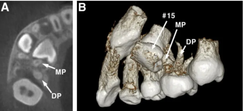 Fig.  4. Panoramic  radiographs  after  extraction  of  the  primary  maxillary  right  second  molar  of  case  1