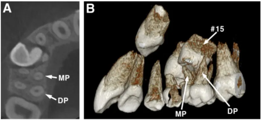 Fig. 8. Panoramic radiographs after extraction of the primary maxillary right second molar of case 2