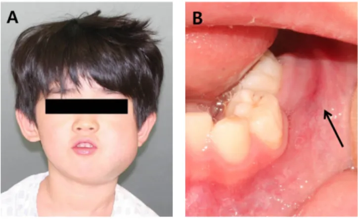 Fig. 2. Initial radiographs. (A) Panoramic radiograph showing radiolucent osteolytic lesion and the destruction of cortical bone in the left mandibular area.