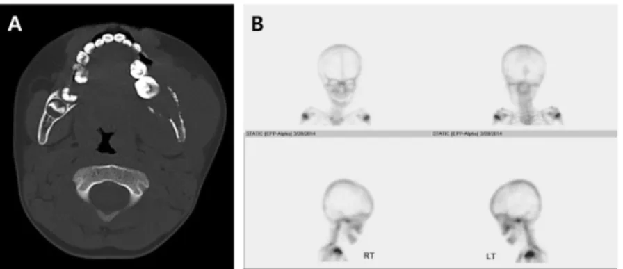 Fig. 3. (A) Computed tomography (CT) of the facial bone showing an osteolytic lesion and cortical bone destruction
