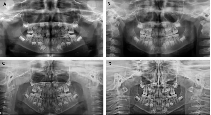 Fig. 1. Panoramic radiographs of reversible and irreversible ectopic eruption. Initial (A) and follow-up (B) panoramic radiograph classified as reversible ectopic eruption