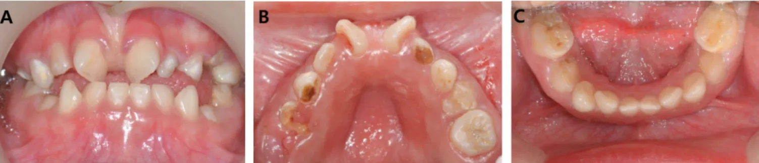 Fig. 3. Periapical radiographs before caries treatment. These images show several congenital missing teeth except for the maxillary central incisors, the right lateral incisor, the right canine, and permanent first molars.