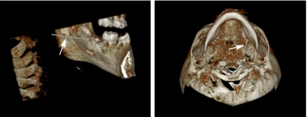 Fig. 1. Panoramic radiograph and axial computed tomographic scans of a patient with a fractured needle fragment in the oral cavity (arrowhead).