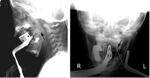 Fig. 3. Lateral and anteroposterior radiographs with two reference needles to determine the position of the fractured needle fragment at the time of operation (arrowhead).