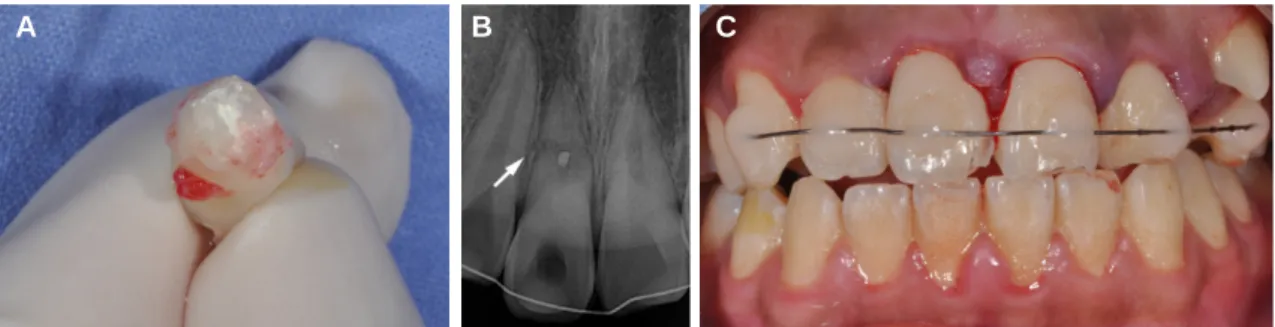 Fig.  2. Operational  procedure  for  intentional  replantation.  (A)  After  extraction  of  the  coronal  segment  of  the  maxillary  right  central  incisor,  cavity preparation was carried out to a depth of 2-3 mm using a #330 high-speed carbide bur
