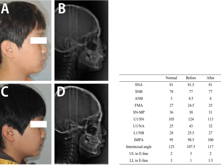 Fig. 3. Profile and lateral cephalogram comparison before (A, B) and after (C, D) the treatment of case 2.