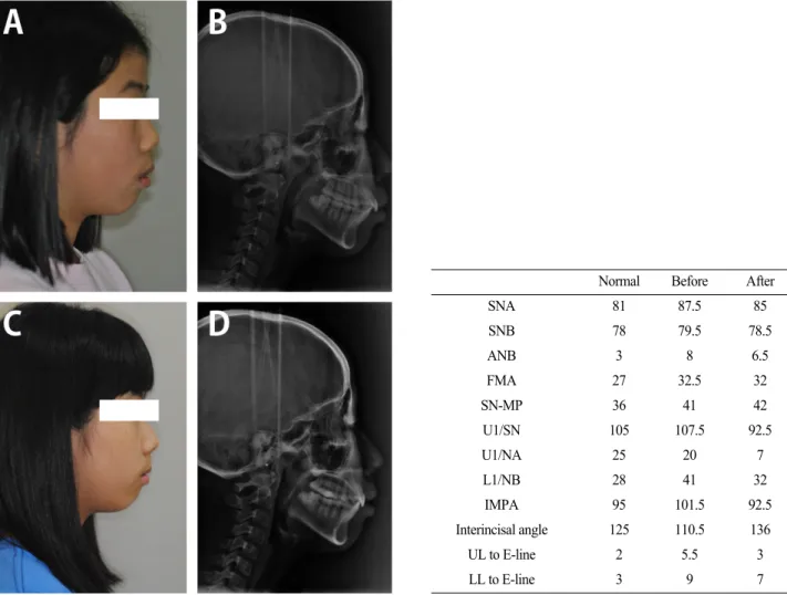 Fig. 5. Profile and lateral cephalogram comparison before (A, B) and after (C, D) the treatment of case 3.