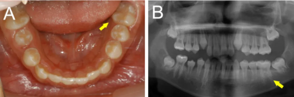 Fig. 3. Case 1. After 14 months, the tooth had reached to the normal occlusal level. (A) Intra-oral view