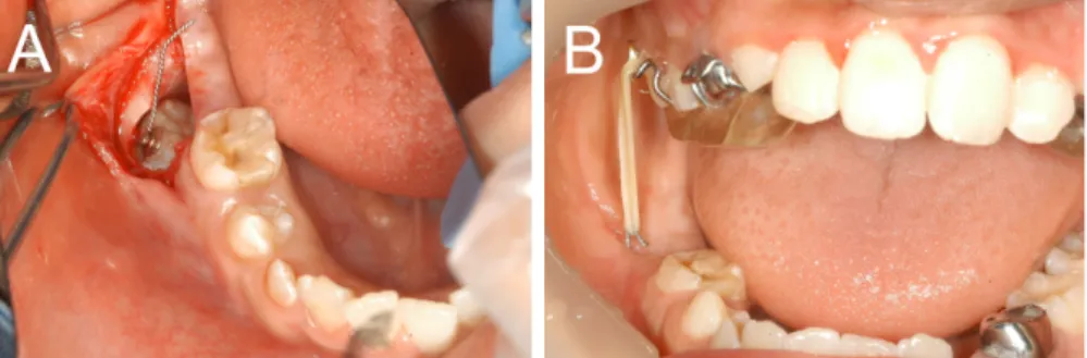 Fig. 6. Case 2. After 15 months, the tooth had reached the normal occlusal level. (A), (B) Intra-oral views