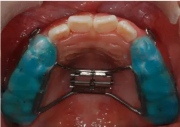 Fig. 1. The bonded expander covered four teeth (primary canine, first and second primary molars, and first permanent molar) on each side.
