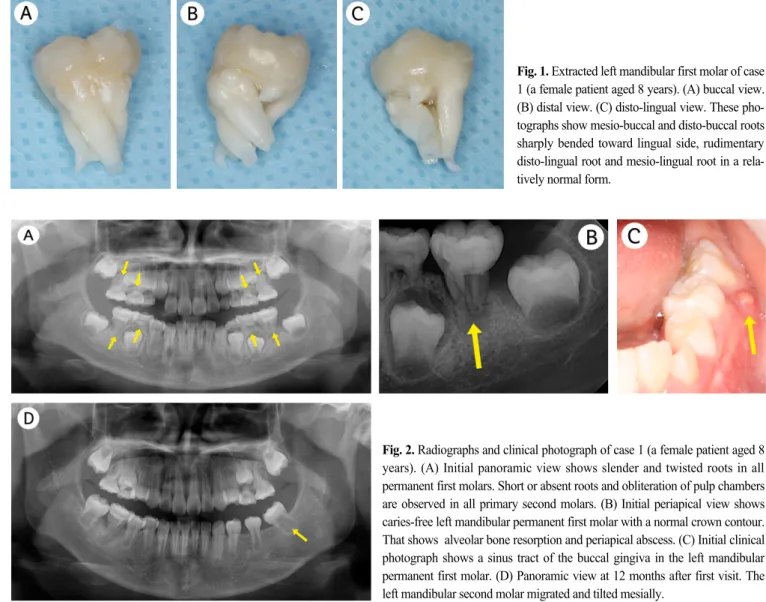 Fig. 1. Extracted left mandibular first molar of case 1 (a female patient aged 8 years)