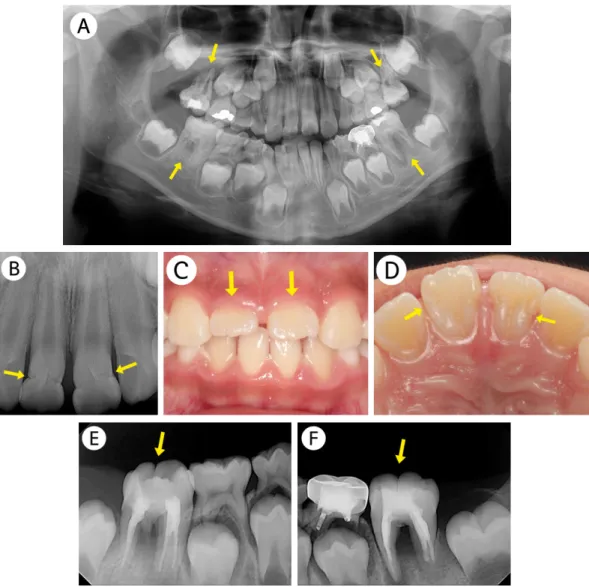 Fig. 4. Radiographs of case 3 (a female patient aged 3 years). (A) Initial panoramic view shows short or rudimentary roots in all primary second molars.