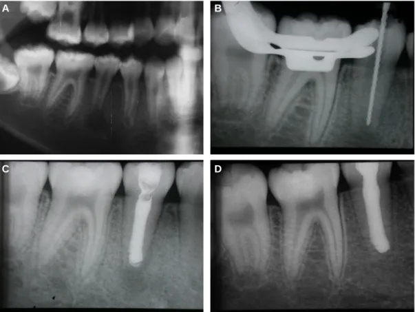 Fig 1. (A) Panoramic radiograph showing an open apex with a periradicular radiolucency of a tooth #45