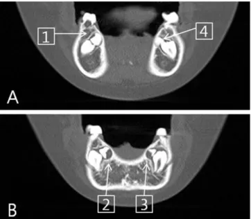 Fig. 1. Panoramic view of case 1. Four impacted supernumerary teeth are seen in radiographic image