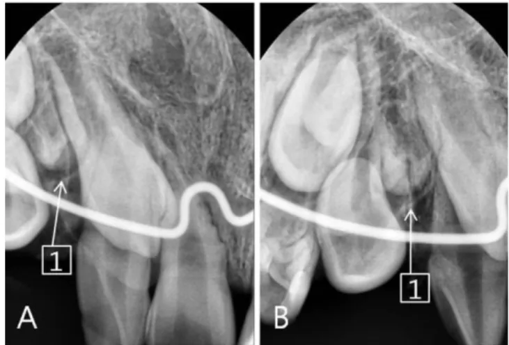 Fig.  4. Panoramic  view  of  case  2.  Supernumerary  teeth  are  not  formed yet.