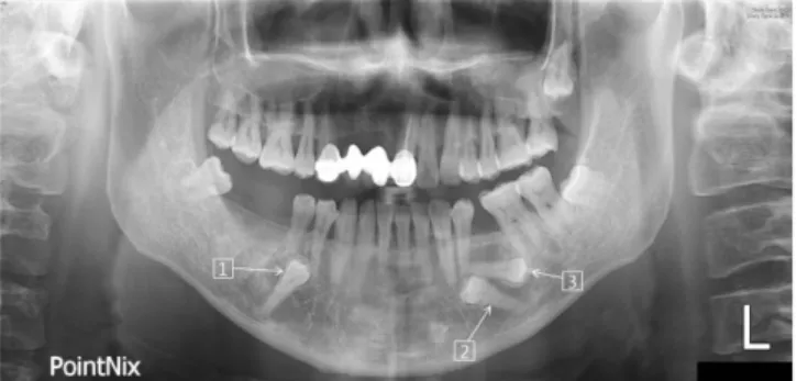 Fig. 10. 2 year-after panoramic view of case 4. There is no specific differ- differ-ence associated with impacted teeth.