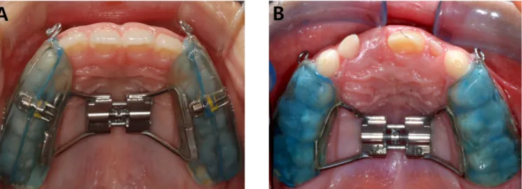 Fig. 1. Intraoral appliance used in this study. (A) Group 1 (splinting four teeth on each side)