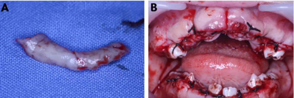 Fig. 4. (A) A slice of gingival tissue resected surgically (B) Post-operative photograph