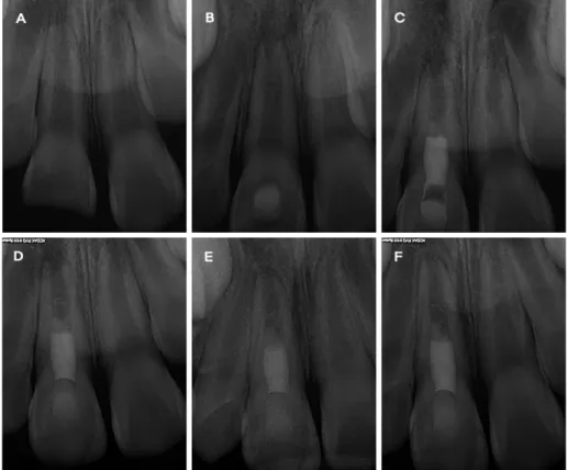 Fig. 6. Periapical views of case 2. (A) Initial visit; maxillary right central incisor with an open apex and uncomplicated crown fracture
