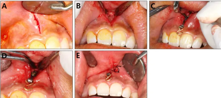 Fig. 2. Procedure of inserting I-type C-tube into the maxillary labial frenum. (A) Incision is made on the mucogingival junction area with a #15 blade after checking the insertion site with an explorer under local anesthesia