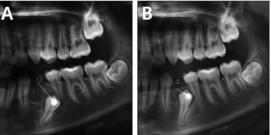 Fig. 4. Panoramic view of spontaneous eruption. (A) Panoramic view right after odontoma was removed