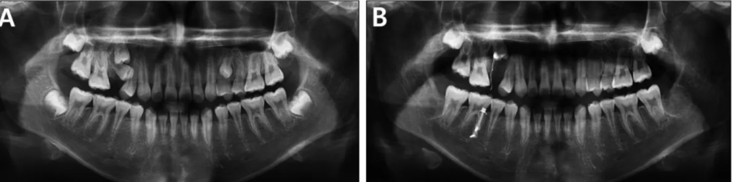 Fig. 6. Panoramic view examination. (A) Supernumerary tooth was examined on both sides of the maxillary premolar area on the panoramic examination.