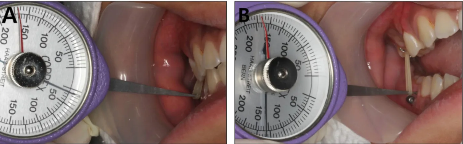 Fig. 8. Traction force check using a force gauge after applying a rubber elastic. After applying a 3/16 " 3.5 oz rubber elastic, (A) 15 g of traction force was generated at mouth closing position