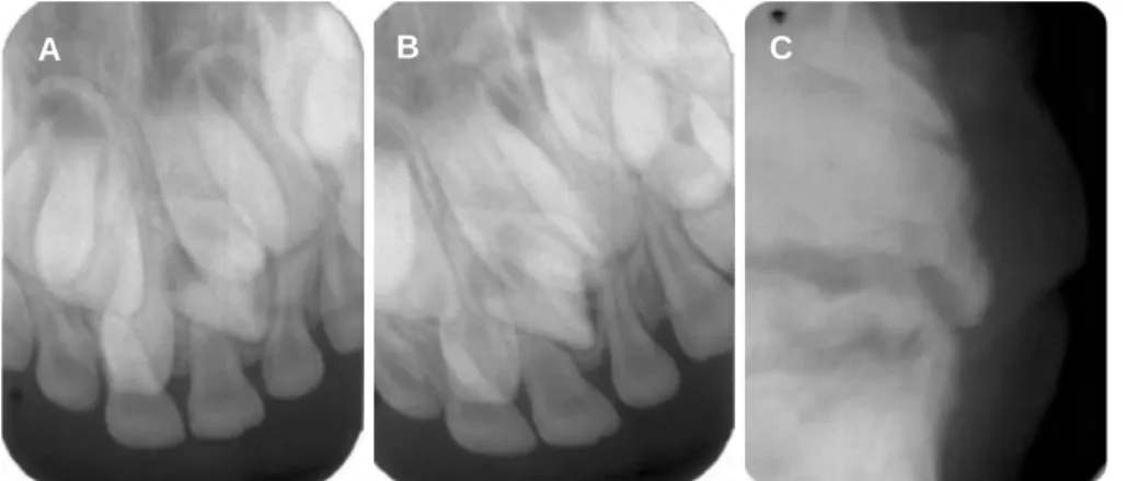 Fig. 4. (A) Panoramic view at 5 months later after surgery. (B) Panoramic view at 9 months later after surgery.