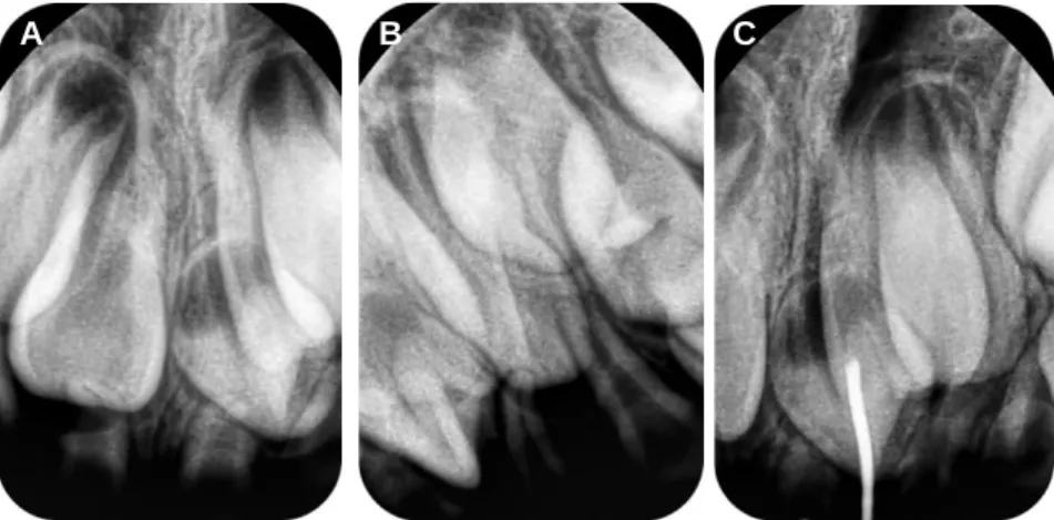 Fig. 5. (A) and (B) Two intraoral periapical radiographs for localization before second operation