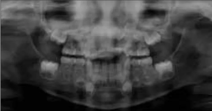 Fig. 9. Periapical view at 12-month follow-up.