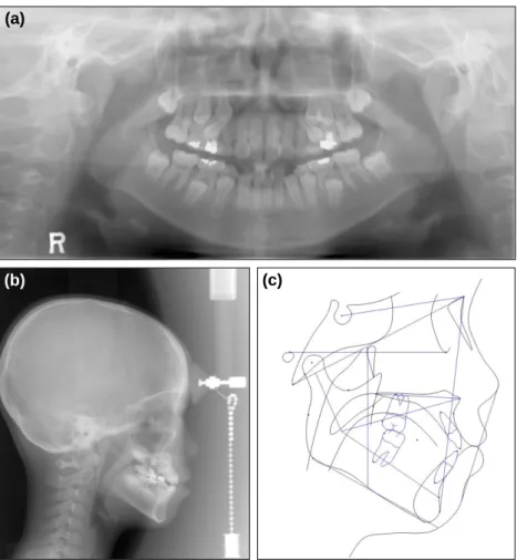 Fig. 4. Initial radiographs. (a) Panoramic radiograph. The root apices of the first premolars on both sides were located mesially to the canines