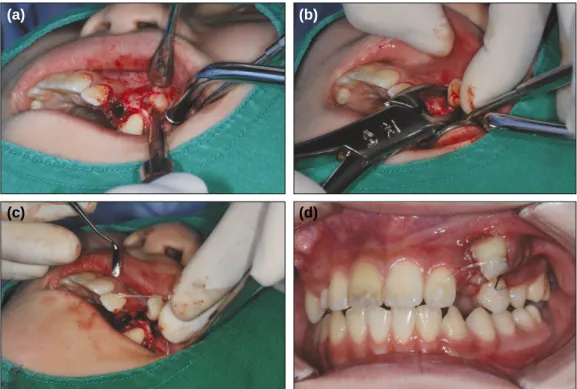 Fig. 11. Final records. (a) Panoramic radiograph. The root apex of  the maxillary left first premolar is dilacerated due to the canine