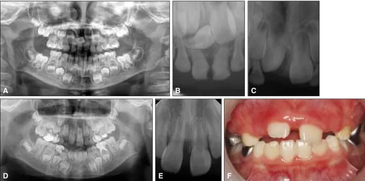 Fig. 3. Panoramic and periapical radiographs of the case 3. (A) Panoramic radiograph at the first visit showing the rotation of the maxillary right permanent central incisor due to the presence of mesiodens