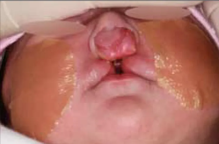 Fig.  1. Bilateral  cleft  with  absent  columella,  wide  nasal  tip,  protruded premaxilla, and separated lip segments.