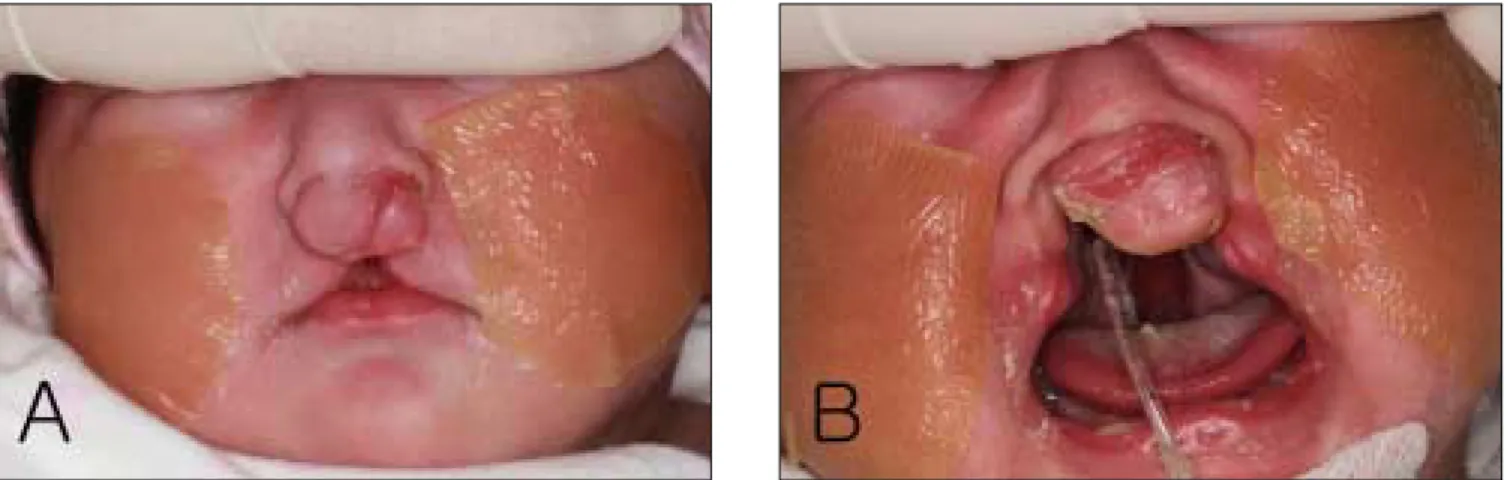 Fig. 2. (A) Extraoral views of patient A(bilateral cleft lip) on the first dental examination