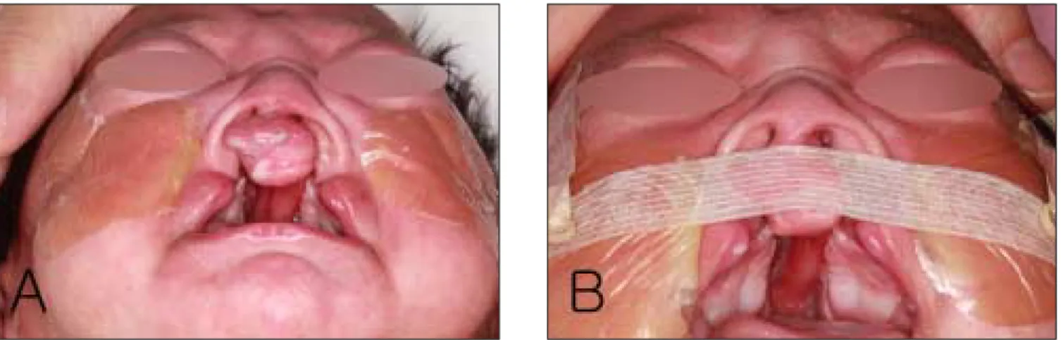 Fig. 6. Extraoral views of patient B on the second(A) and eighth(B) nasal moldings.