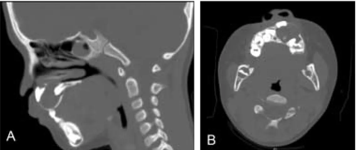Fig. 2. Sagittal view of CT (A) shows that the cyst involves the crown of supernumerary tooth, and the axial view (B) shows that the position of maxillary central incisor is deviated due to the cyst.